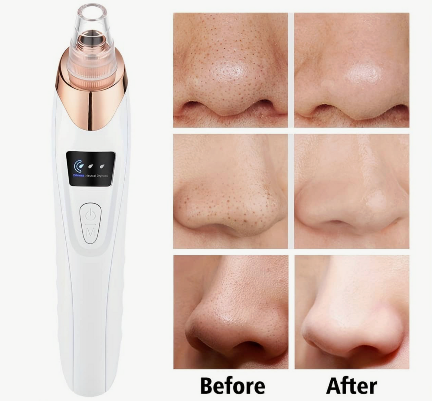 MIRENI BLACKHEAD REMOVER™