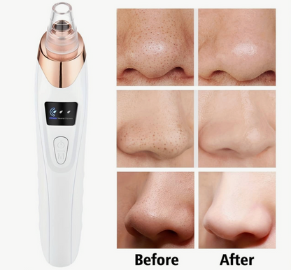 MIRENI BLACKHEAD REMOVER™